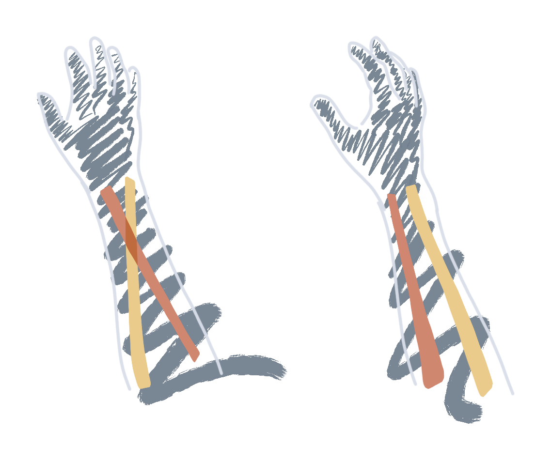 illustration to showcase the benefit of a tented split keyboard